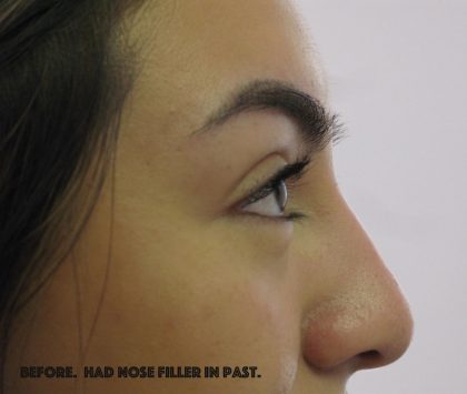 Facial Fillers Before & After Patient #2491