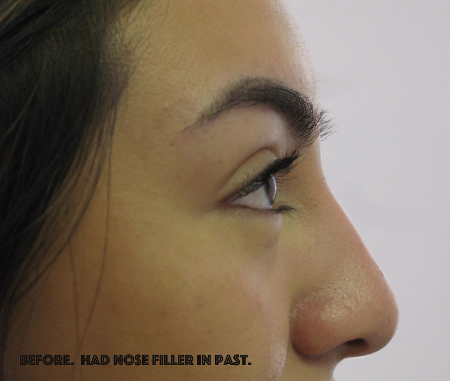 Non-Surgical Rhinoplasty Before & After Patient #2491