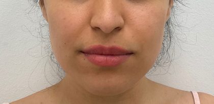 Lip Fillers Before & After Patient #2485