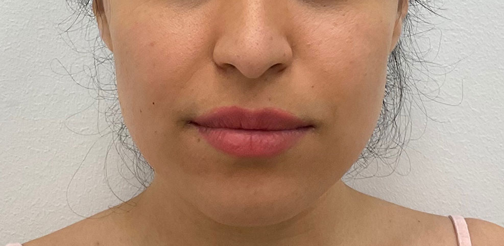 Lip Fillers Before & After Patient #2485