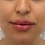 Lip Fillers Before & After Patient #2485