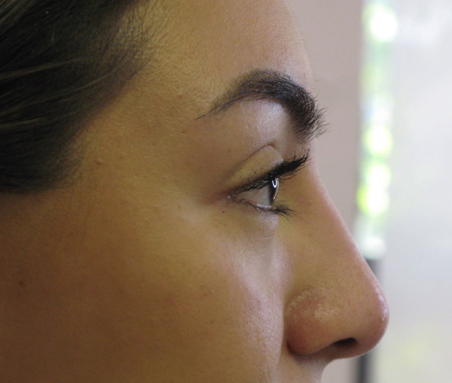 Non-Surgical Rhinoplasty Before & After Patient #2491