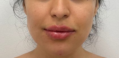 Lip Fillers Before & After Patient #2485