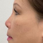 Non-Surgical Rhinoplasty Before & After Patient #2501