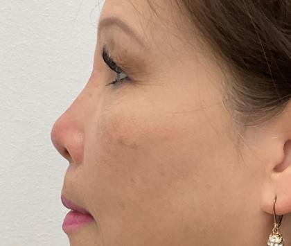 Non-Surgical Rhinoplasty Before & After Patient #2501