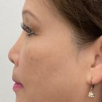 Non-Surgical Rhinoplasty Before & After Patient #2501