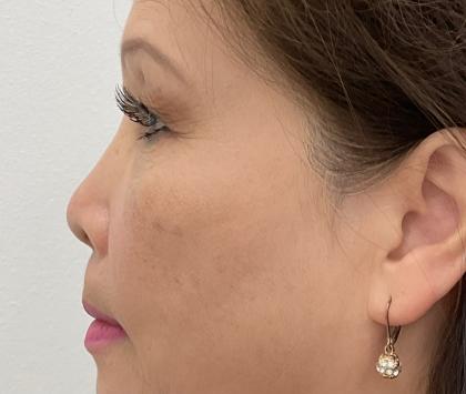 Non-Surgical Rhinoplasty Before & After Patient #2501