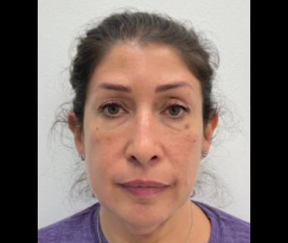 Botox Before & After Patient #2513