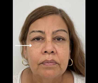 Lower Blepharoplasty Before & After Patient #2509