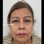 Lower Blepharoplasty Before & After Patient #2509