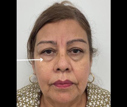 Lower Blepharoplasty Before & After Patient #2509