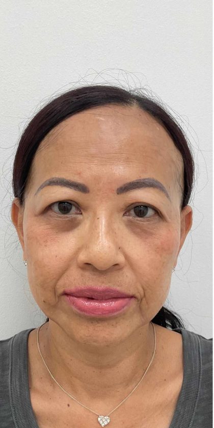 Botox Before & After Patient #2516