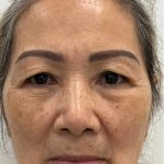 Blepharoplasty Before & After Patient #2520