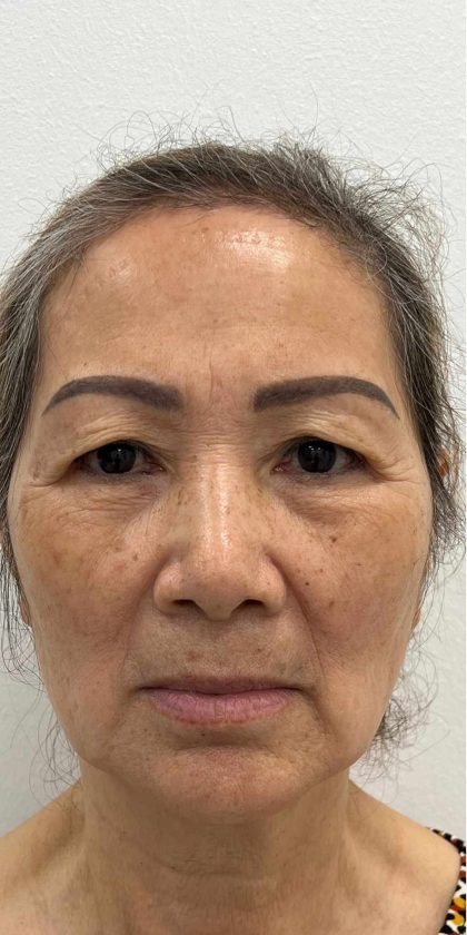 Blepharoplasty Before & After Patient #2520