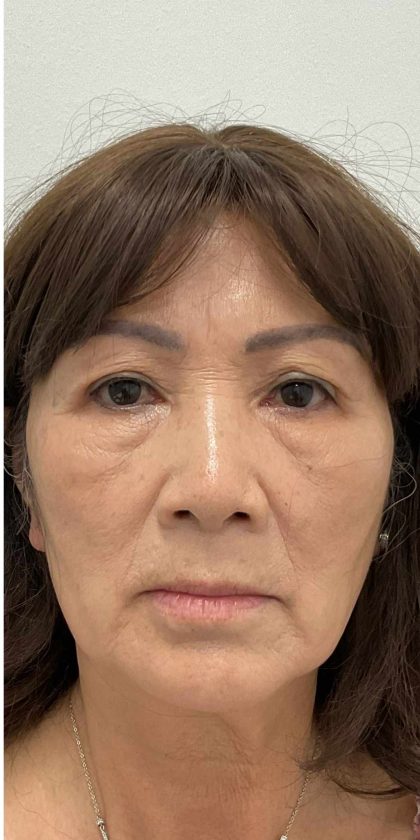 Blepharoplasty Before & After Patient #2520