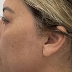 Non-Surgical Rhinoplasty Before & After Patient #2532