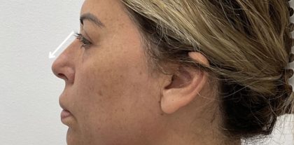 Non-Surgical Rhinoplasty Before & After Patient #2532