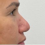 Non-Surgical Rhinoplasty Before & After Patient #2523