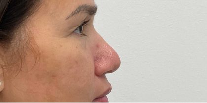 Non-Surgical Rhinoplasty Before & After Patient #2523