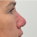 Non-Surgical Rhinoplasty Before & After Patient #2523