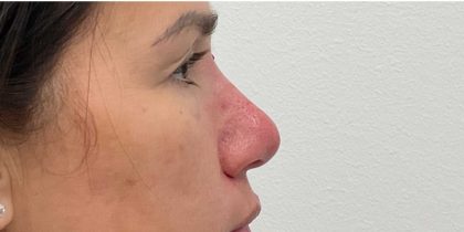 Non-Surgical Rhinoplasty Before & After Patient #2523