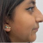 Non-Surgical Rhinoplasty Before & After Patient #2526