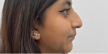 Non-Surgical Rhinoplasty Before & After Patient #2526