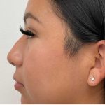 Non-Surgical Rhinoplasty Before & After Patient #2529