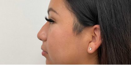 Non-Surgical Rhinoplasty Before & After Patient #2529