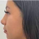 Non-Surgical Rhinoplasty Before & After Patient #2529