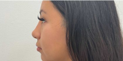 Non-Surgical Rhinoplasty Before & After Patient #2529