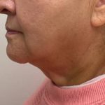 Chin Augmentation Before & After Patient #2584