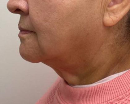 Chin Augmentation Before & After Patient #2584