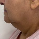 Chin Augmentation Before & After Patient #2584