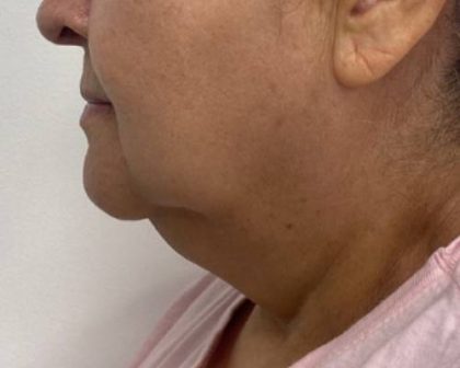 Chin Augmentation Before & After Patient #2584