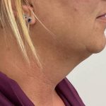 Kybella Before & After Patient #2587