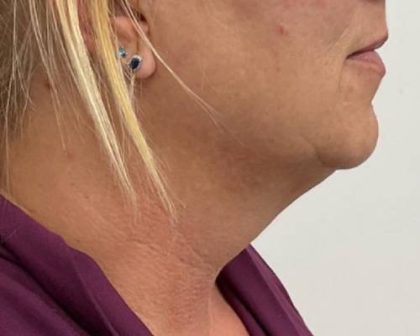 Kybella Before & After Patient #2587