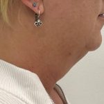 Kybella Before & After Patient #2587