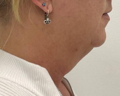 Kybella Before & After Patient #2587