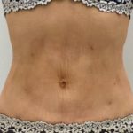 Liposculpture Before & After Patient #2578