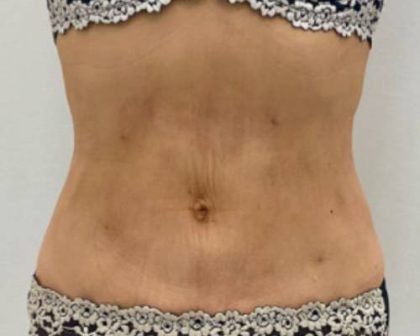 Liposculpture Before & After Patient #2578