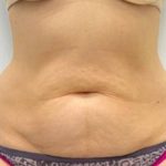 Liposculpture Before & After Patient #2578