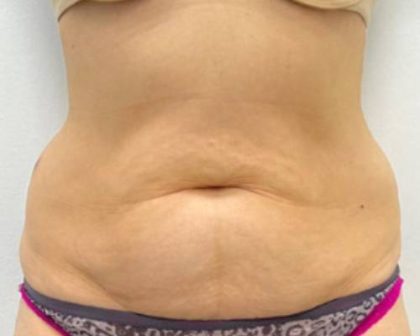 Liposculpture Before & After Patient #2578