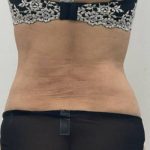 Liposculpture Before & After Patient #2578