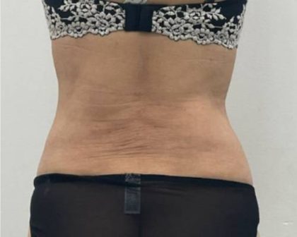 Liposculpture Before & After Patient #2578