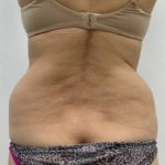 Liposculpture Before & After Patient #2578