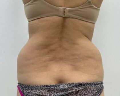 Liposculpture Before & After Patient #2578