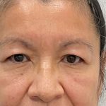 Blepharoplasty Before & After Patient #2623