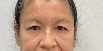 Blepharoplasty Before & After Patient #2623