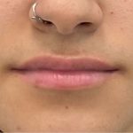 Lip Fillers Before & After Patient #2629